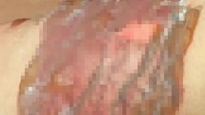 [Bintang] Luka Bakar