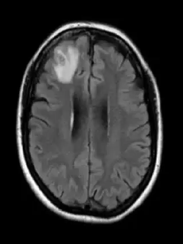 Dokter melihat kelainan otak pada pemindaian MRI pasien, yang kemudian mendorong dilakukannya operasi otak.