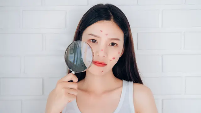 Kenali Serum Jerawat untuk Remaja: Manfaat dan Tips Memilih Produk yang Tepat