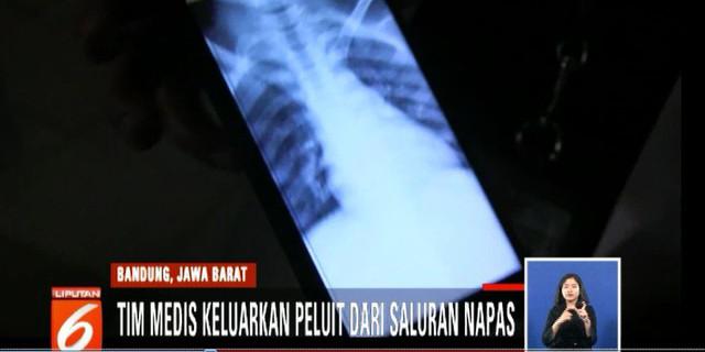 Peluit yang Tertelan Bocah di Bandung Berhasil Dikeluarkan