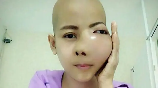 Sakit Gigi Dahsyat, Gadis Ini Ternyata Idap Kanker Tulang 