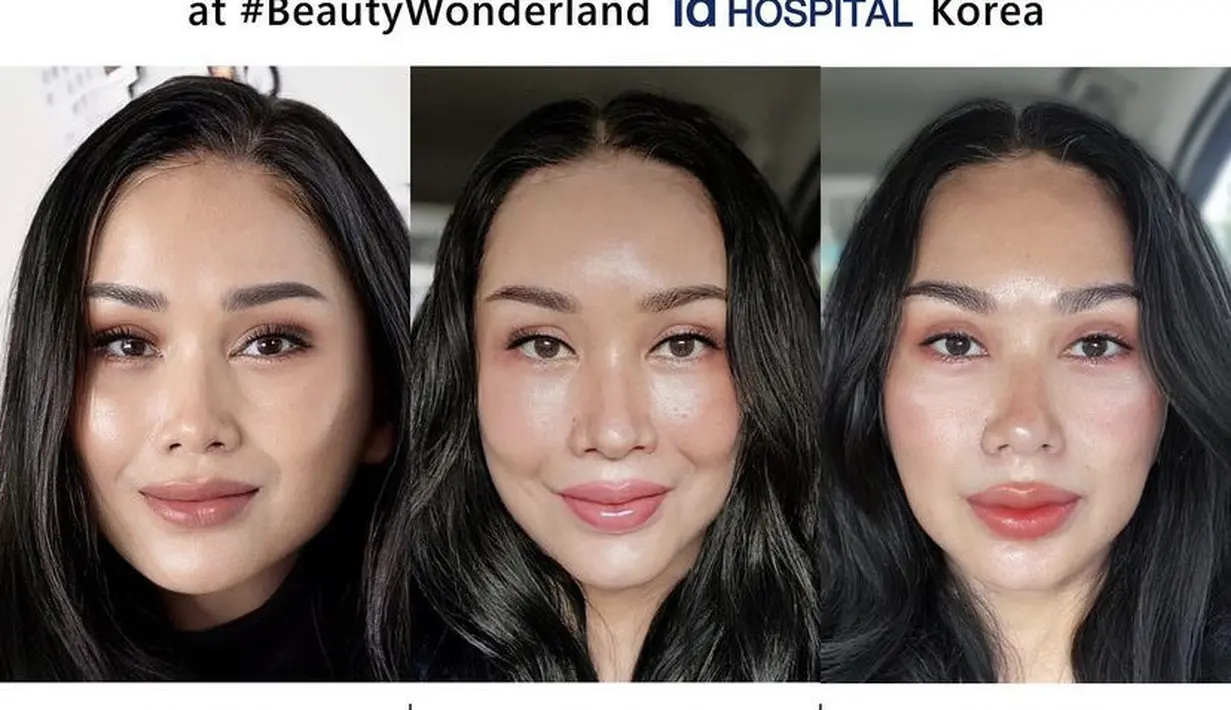Setelah satu bulan, Titi DJ membagikan potret terbaru wajahnya yang telah melalukan operasi anti aging. (@ti2dj)