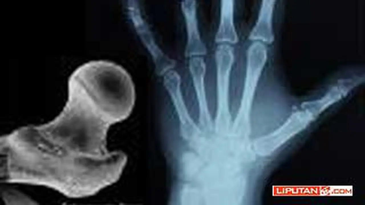 100217ckesehatan_osteoporosis.
