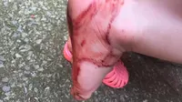 Gadis kecil berusia 2 tahun ini mendapatkan luka pada kakinya setelah menggunakan sandal Jelly.