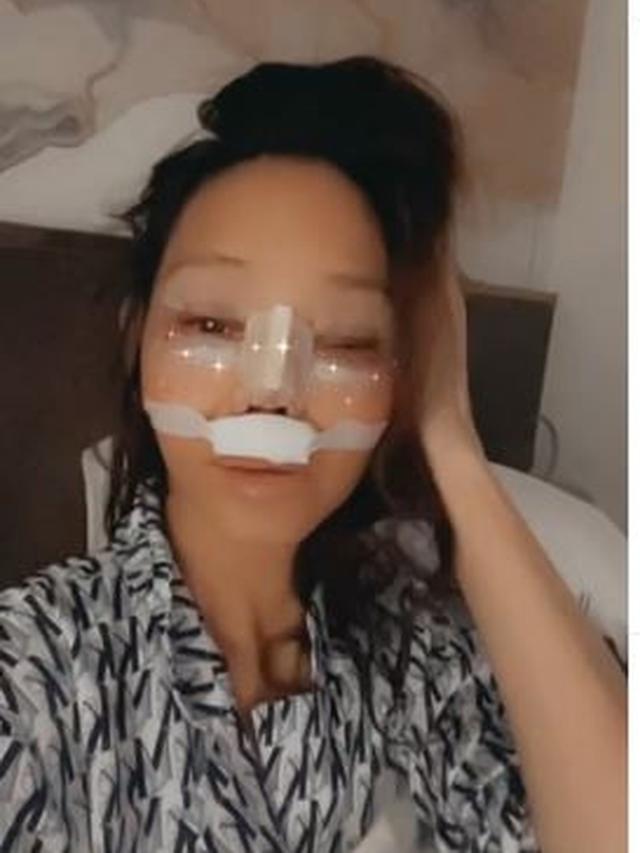 Bunda Corla Operasi Plastik, Ini 6 Potretnya dengan Perban dan Wajah Lebam