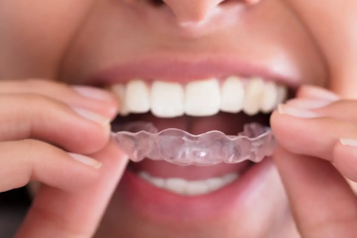 Ilustrasi Retainer