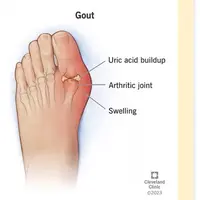 Penumpukan asam urat di sela-sela sendi (Dok Cleveland Clinic)