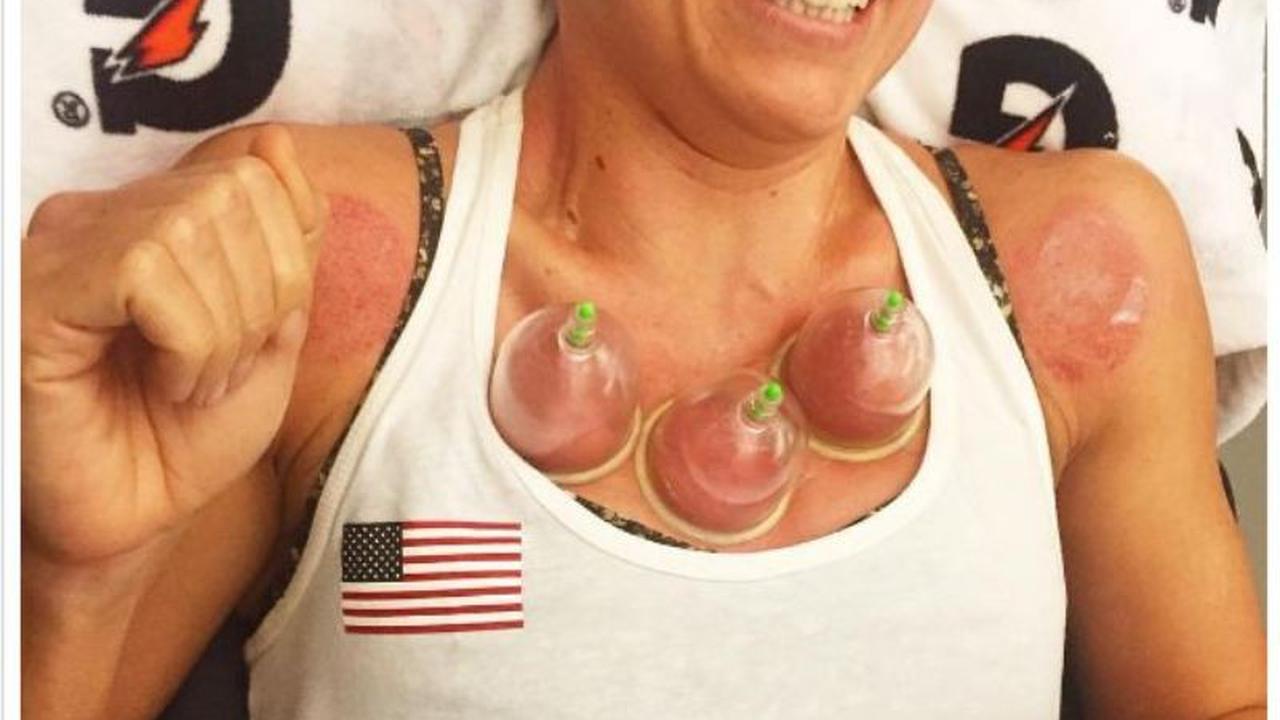 Atlet renang asal Amerika Serikat Natalie Coughlin menjalani terapi bekam. (Instagram/nataliecoughlin)