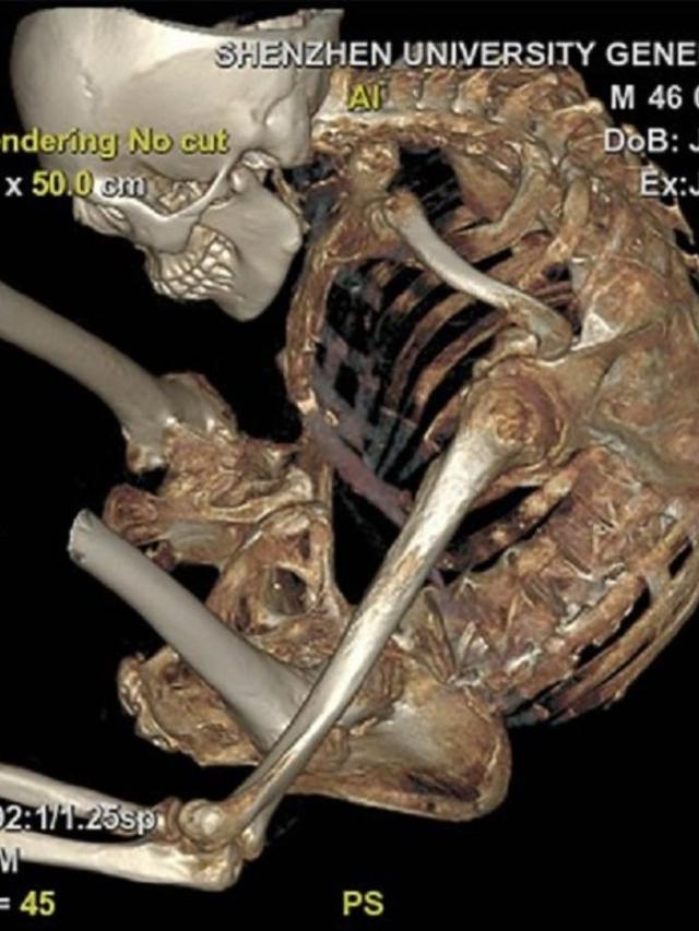 28 Tahun Hidup Membungkuk, Pria Ini Akhirnya Bisa Berdiri Tegak Kembali