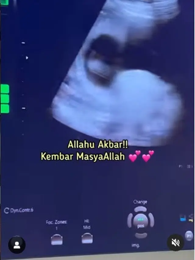 Anisa Rahma eks Cherrybelle hamil anak kembar (Foto: Instagram @ananditodwis)