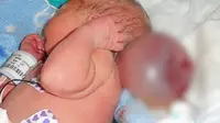 Kisah Perjuangan Bayi dengan Otak di Luar Tengkorak 