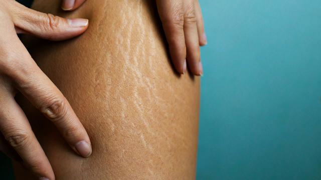 Ilustrasi stretch mark