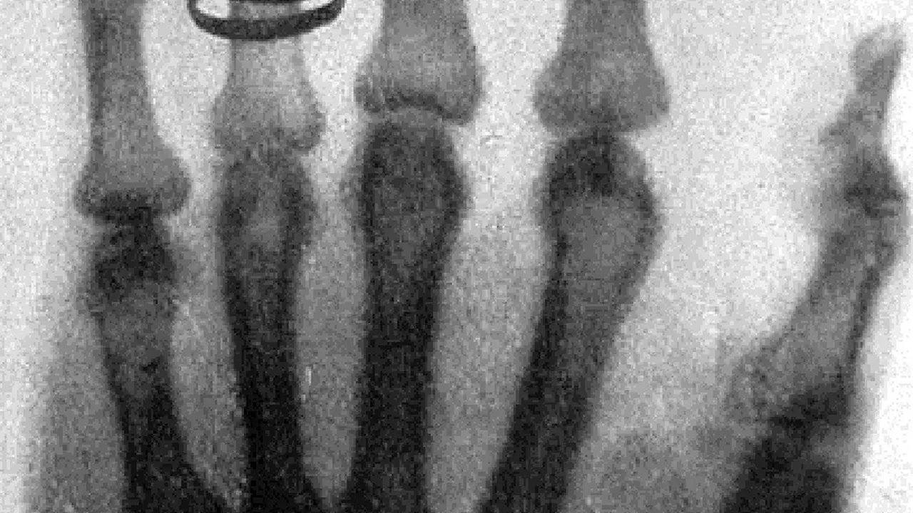 X-ray