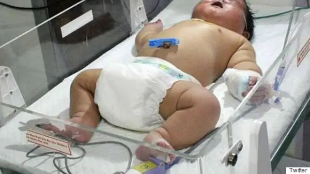 Lahirkan Bayi Seberat 6,7 Kg, Wanita India Ini Butuhkan 15 Menit