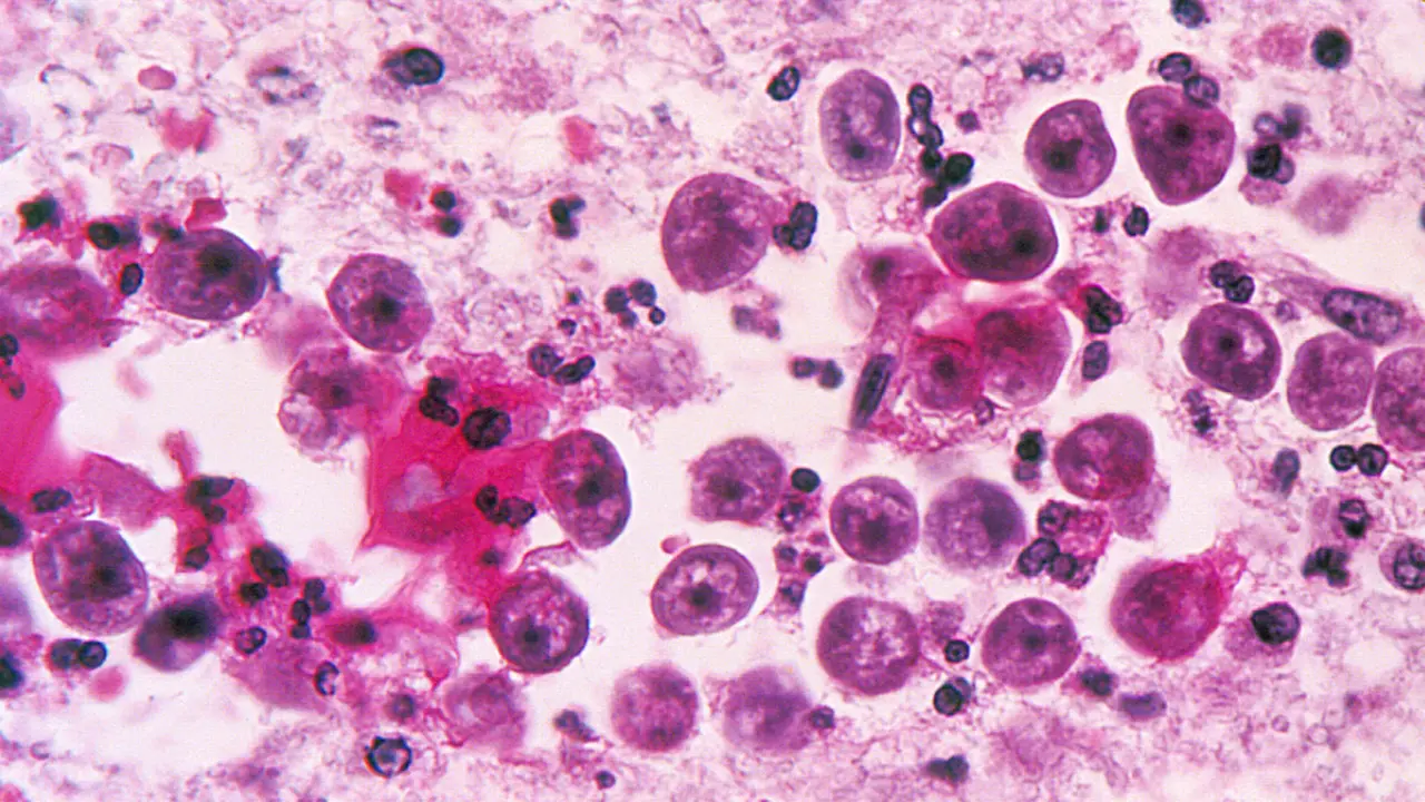 Amuba pemakan otak, Naegleria fowleri
