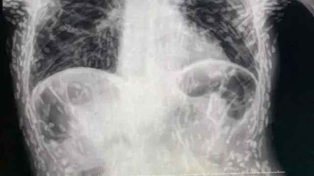 Sinar X-ray dari tubuh pria (Tangkapan layar dari website odditycentral.com)