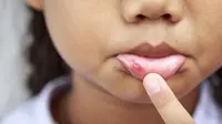 Tak Perlu Cemas, Begini Cara Merawat Anak yang Alami Sariawan