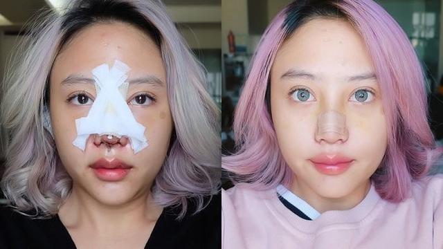 Beda Penampilan 5 Seleb Wanita Tanah Air Jalani Operasi Plastik saat Diperban Vs Setelahnya