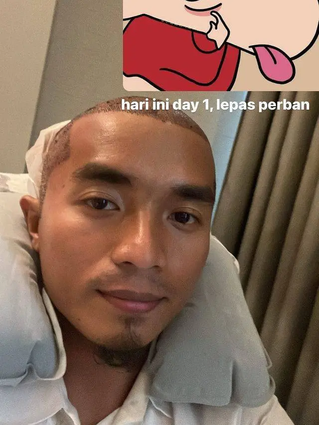 7 Potret Seleb Jalani Transplantasi Rambut, Hasilnya Makin Keren
