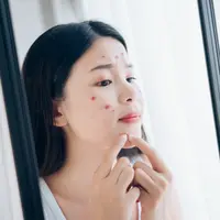 Jerawat yang meradang bisa diatasi dengan beberapa cara/copryight shutterstock/MMD Creative