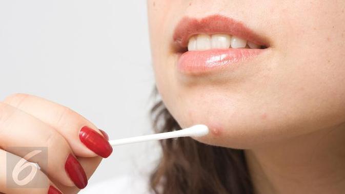 Cara Menghilangkan Flek Hitam Bekas Jerawat Dengan Bahan Alami Health Liputan6 Com