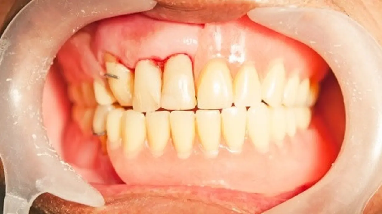 Mengenal Periodontitis
