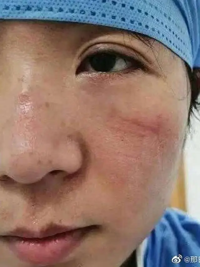 7 Potret Luka Lebam di Wajah Tim Medis Akibat Kacamata Pelindung Selama Perangi Virus Corona