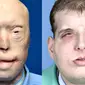 Seorang pemadam kebakaran tercatat sebagai manusia yang paling banyak menjalani operasi plastik pada wajahnya yang pernah terbakar.