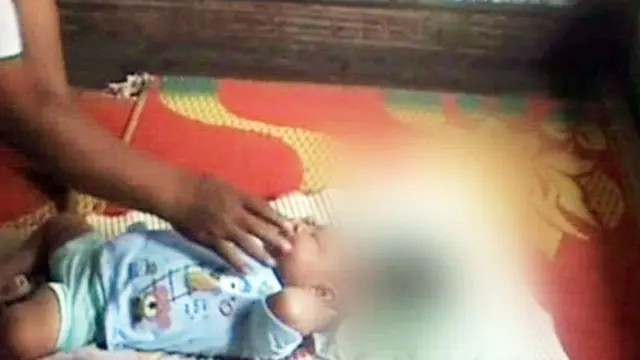 Bayi 7 Bulan Menderita Tumor Ganas di Kepala
