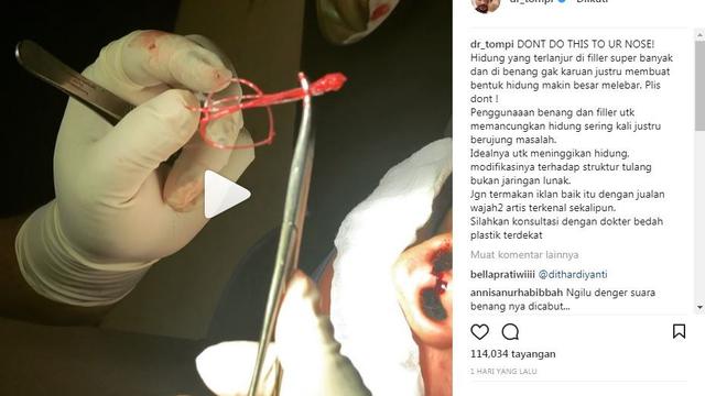 [Bintang] Berminat Tanam Benang? Coba Lihat Dulu Video yang Diunggah Oleh Dr Tompi Ini, Bikin Ngilu