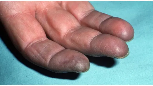 Foto: copyright dermquest.com