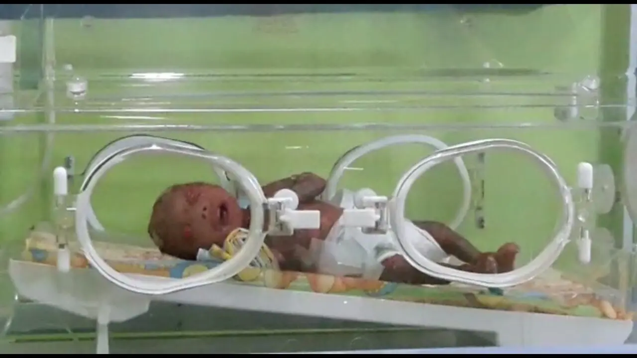 Baru Lahir, Kulit Bayi Perempuan di Kendari Melepuh dan Kering