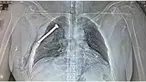 Gambar sinar X-ray ini menunjukkan ada sekrup berukuran besar tertanam di dada korban serangan teror bom Brussels yang terjadi di stasiun metro dan bandara Zaventem pada Selasa, 22 Maret, lalu.
