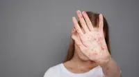 Pernah Kena Campak, Risiko Terinfeksi Lagi Sangat Kecil