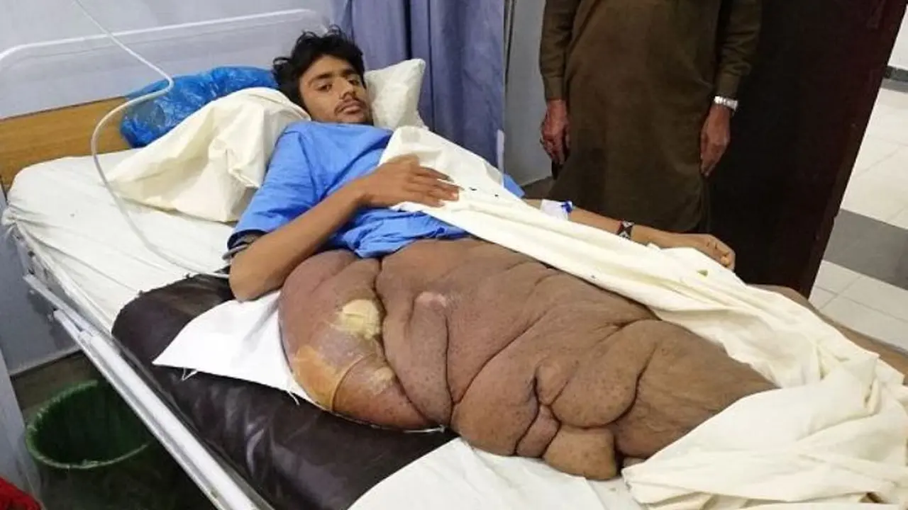 Miliki Tumor 20 Kg di Kaki, Remaja Harap Bantuan Pengobatan