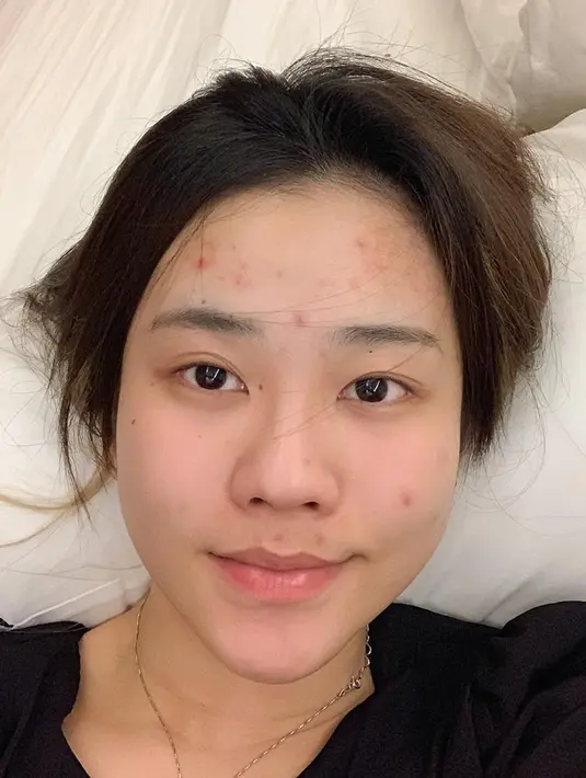 Beberapa waktu lalu, Jessica Jane memperlihatkan penampilan terbarunya yang tengah berjerawat. Ia juga menyebut jika dirinya tidak memakai filter sama sekali. Meski sedang berjerawat, Jessica tetap dipuji cantik. (Liputan6.com/IG/@jessicajane99)