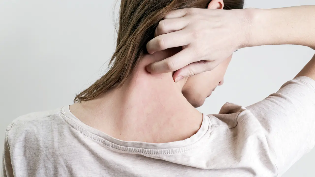 Penyakit Psoriasis