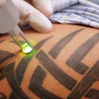 Lihat proses bikin tato sudah biasa, kalau lihat proses penghapusan tato?