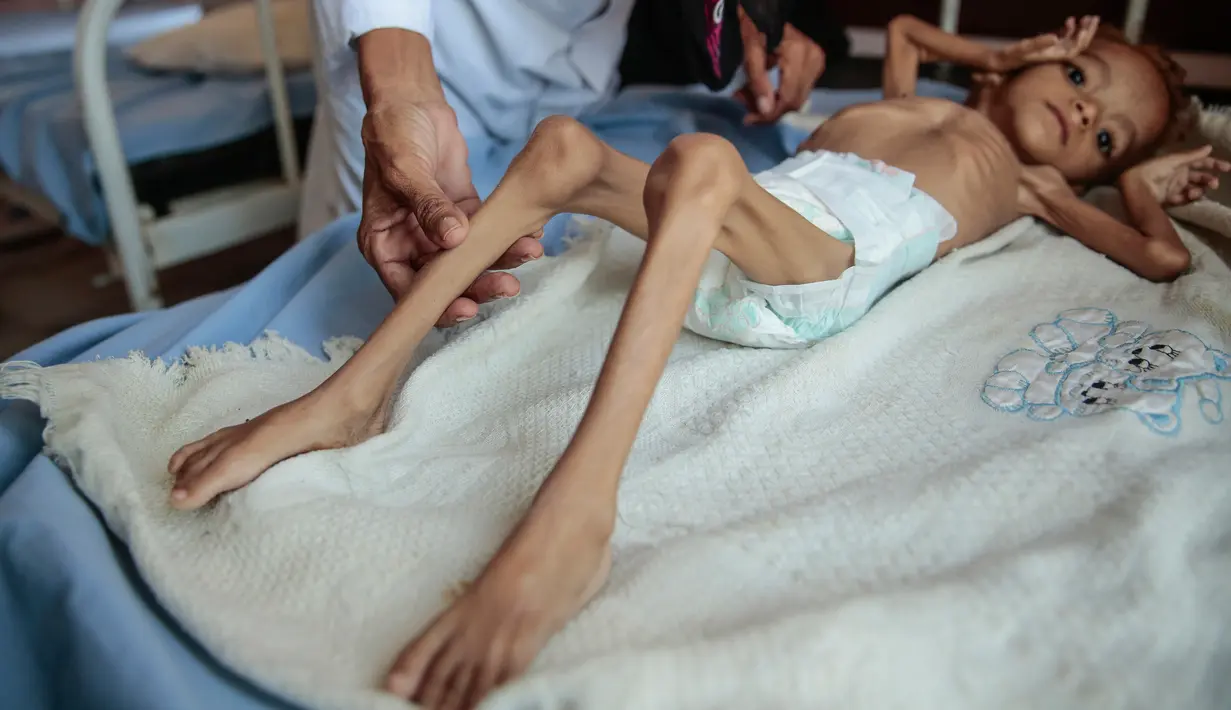 Seorang anak laki-laki penderita gizi buruk berada di tempat tidur rumah sakit di Aslam Health Centre, Hajjah, Yaman (1/11). Malnutrisi, kolera, dan penyakit epidemi lainnya seperti difteri telah menular di daerah tersebut. (AP Photo / Hani Mohammed)