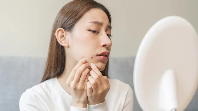 Cara Mengatasi Jerawat Membandel di Wajah