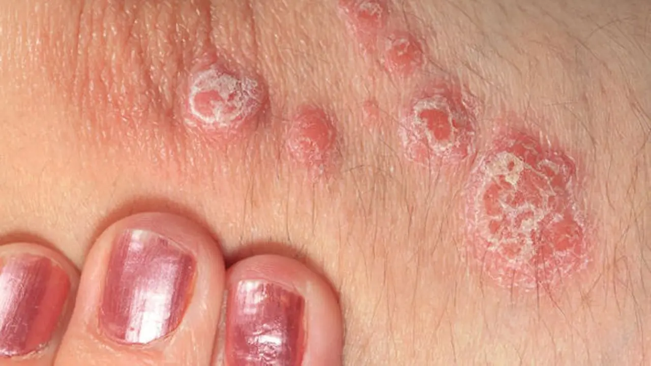 Psoriasis