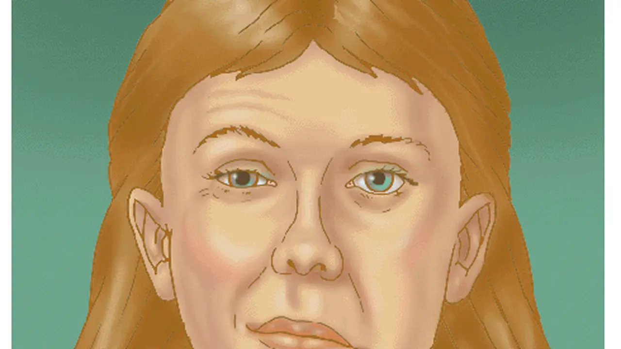 Bell's Palsy, Saat Sebagian Wajah Perot