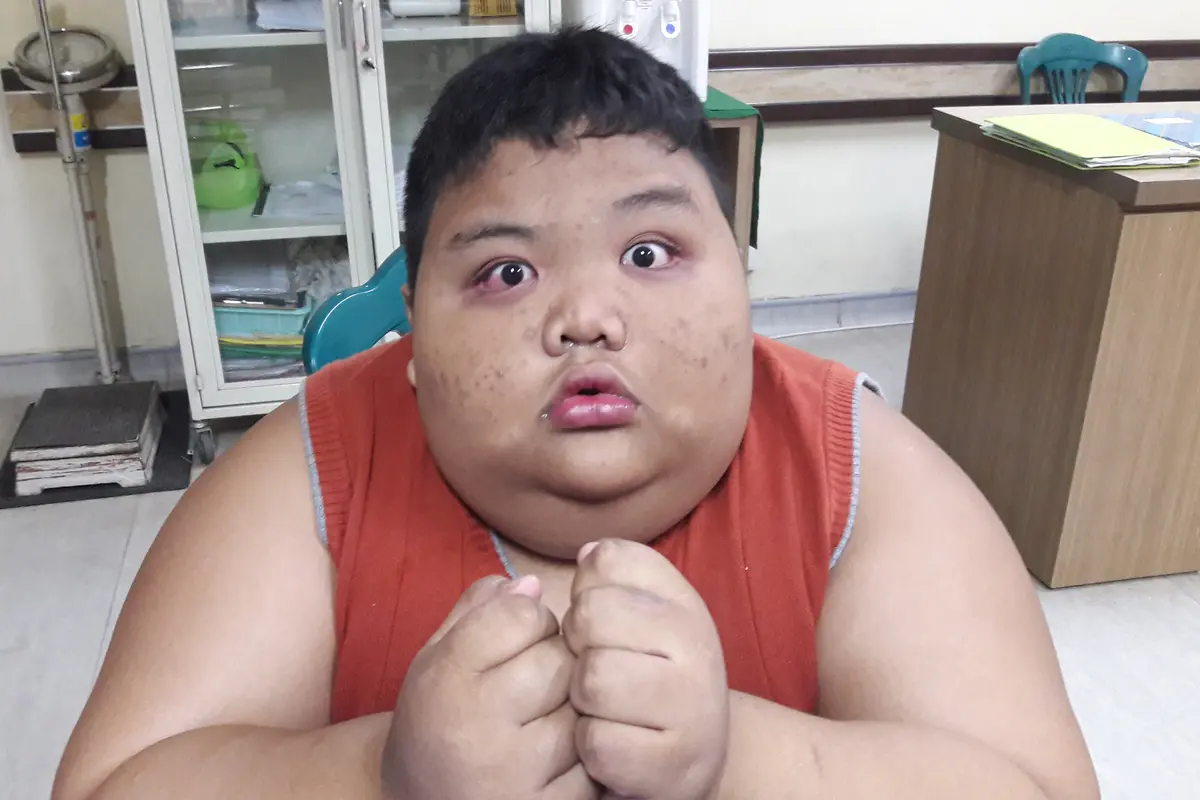 Seusia Arya, Bocah Obesitas Palembang Ini Berbobot 119 Kilogram