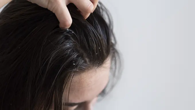 Anti Ribet, Anti Ketombe : Rahasia Kulit Kepala Sehat dengan Bahan Alami di Rumah [Dok/freepik.com]