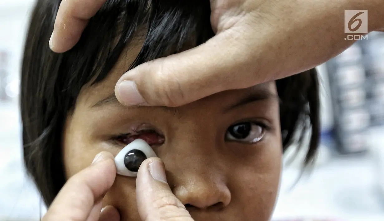 Sebuah bola mata palsu dipasang pada mata pasien anak di Klinik Ilyarsi Okularis, Villa Bintaro Indah, Tangsel, Selasa (15/5). Sebanyak 23 mata palsu dibagikan secara gratis pada Gerakan 1.000 Mata Palsu Gratis. (Liputan6.com/Fery Pradolo)