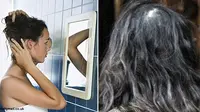 Transplantasi Rambut Lagi Ngetren di London