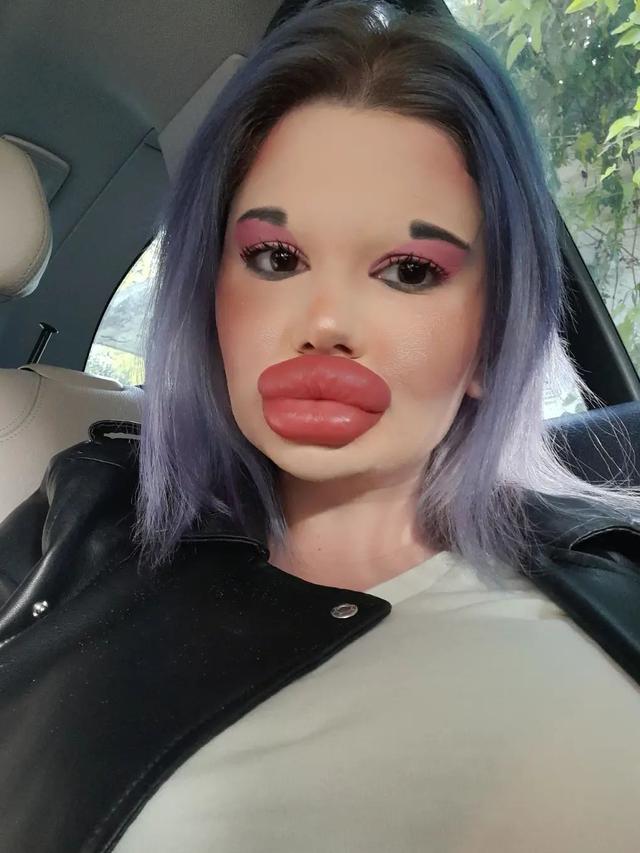 Ingin Tampil Bak Boneka, Wanita Akan Injeksi Bibir Ke 27 Kali Akhir Tahun Ini