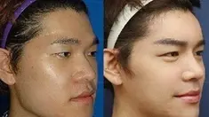 Tak hanya kaum hawa saja yang menjalani operasi plastik, kaum adam pun banyak yang mewujudkan mimpi mereka untuk memiliki wajah bak aktor tampan Korea.