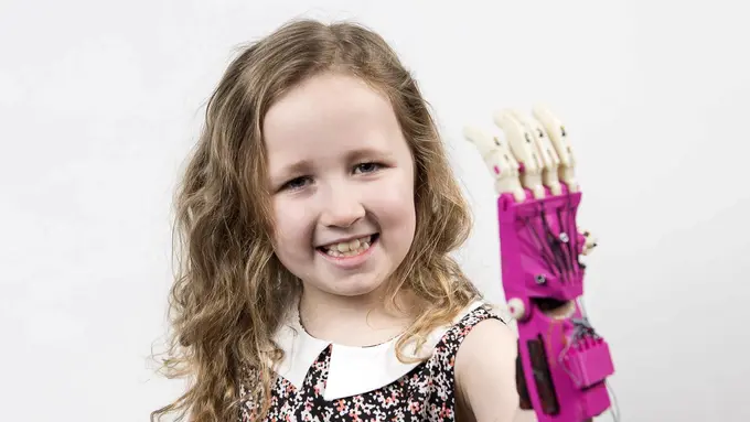 Berkat Printer 3D, Gadis Berlengan Tak Sempurna Ini Jadi Ceria