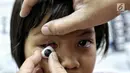 Sebuah bola mata palsu dipasang pada mata pasien anak di Klinik Ilyarsi Okularis, Villa Bintaro Indah, Tangsel, Selasa (15/5). Sebanyak 23 mata palsu dibagikan secara gratis pada Gerakan 1.000 Mata Palsu Gratis. (Liputan6.com/Fery Pradolo)